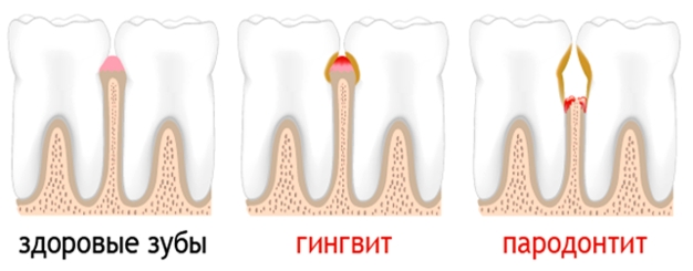 Здоровый зуб, гигнивит, пародонтит-1